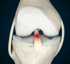 ACL and PCL Reconstruction